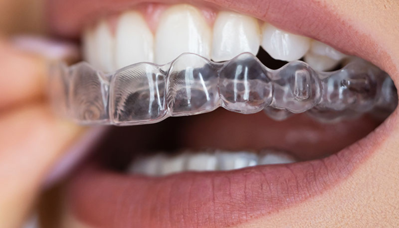 Orthodontie Invisible - Invisalign